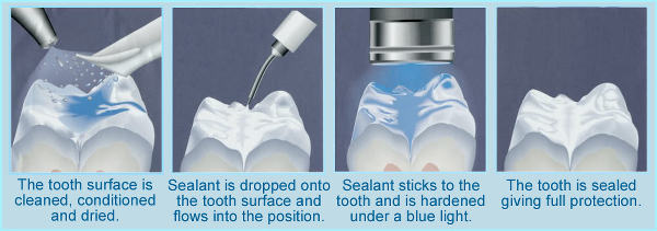 stages%20of%20sealant